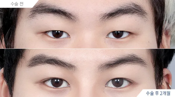Before/After