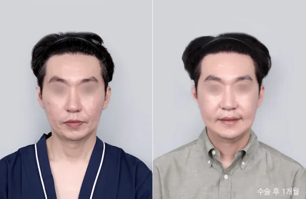 Before/After