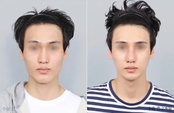 Before/After