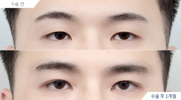 Before/After