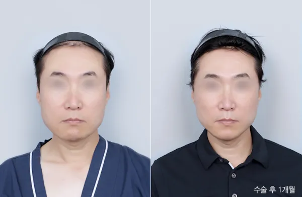 Before/After