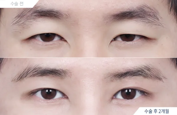 Before/After