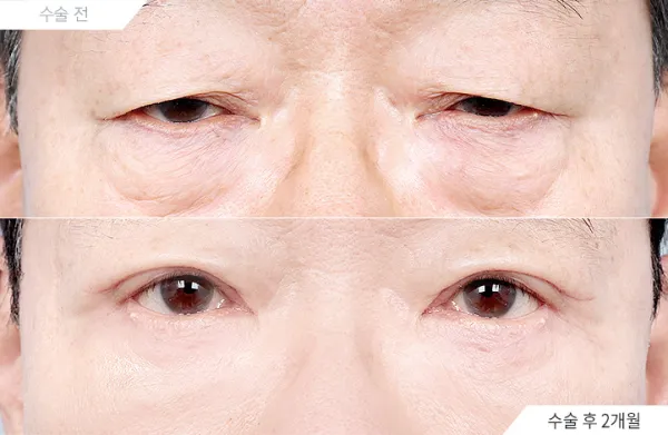 Before/After