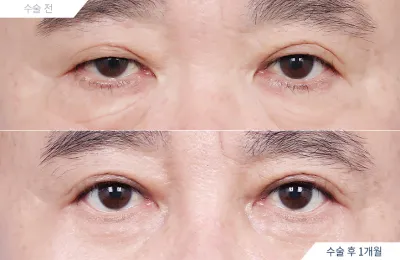 Before & After