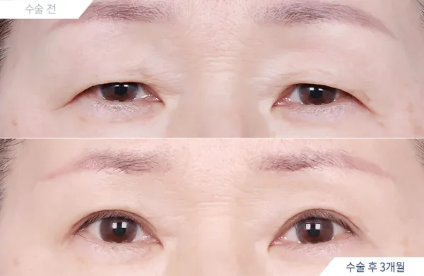 Before/After