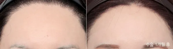 Before/After