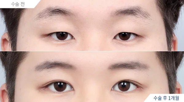 Before/After