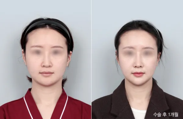 Before/After