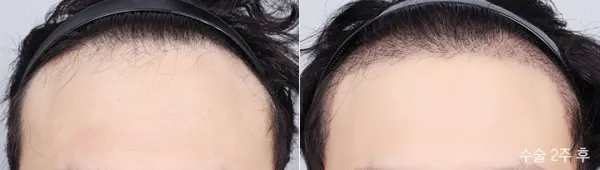 Before/After