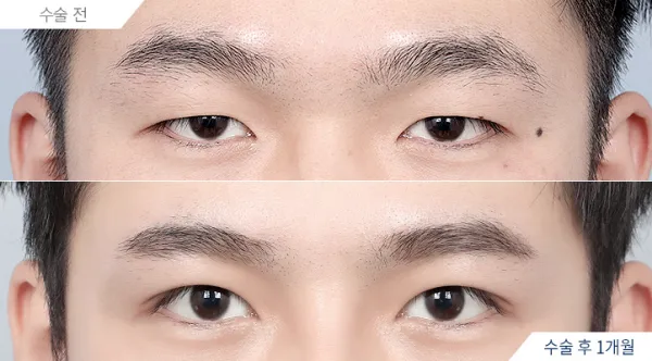 Before/After