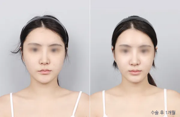 Before/After