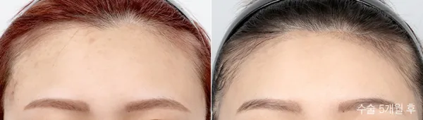 Before/After