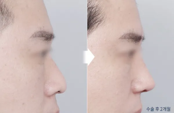 Before/After