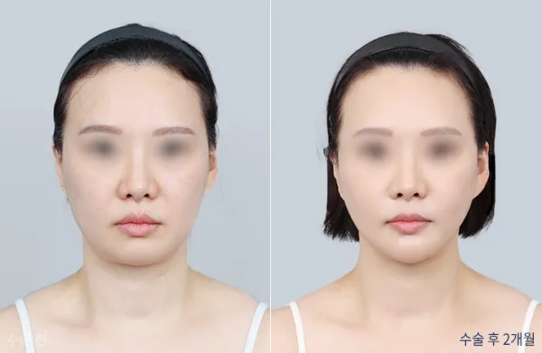 Before/After