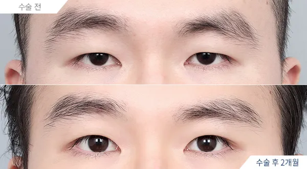 Before/After