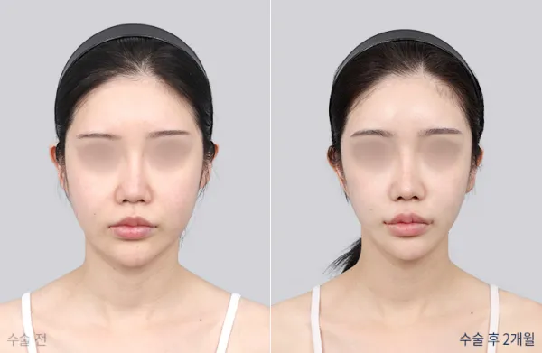 Before/After