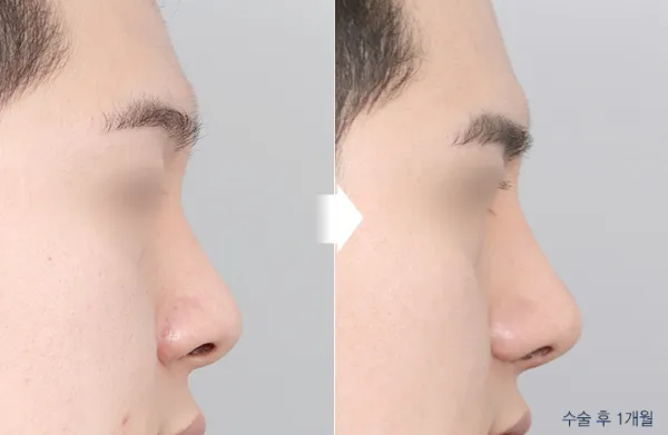 Before/After