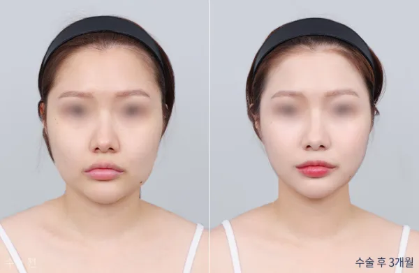 Before/After
