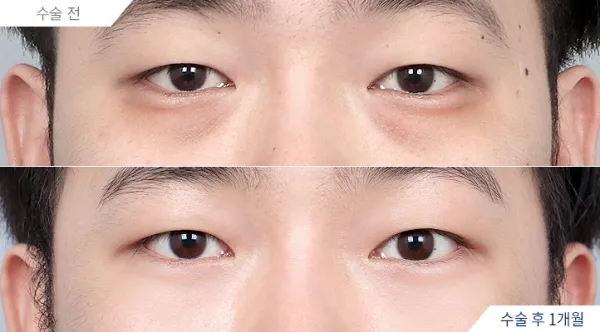 Before/After