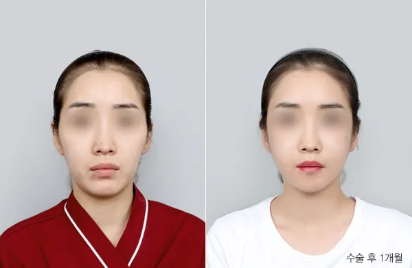 Before/After