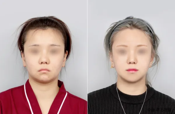 Before/After