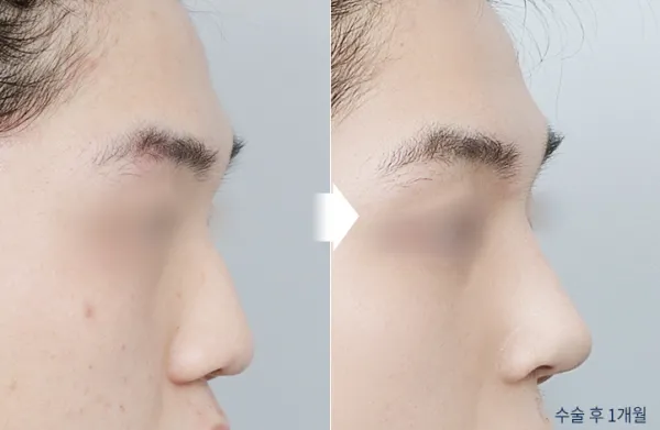 Before/After