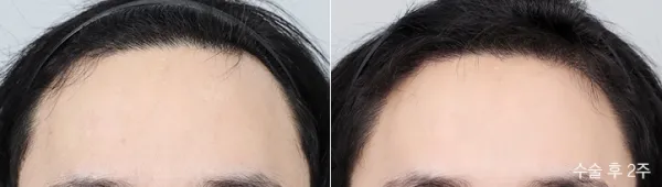 Before/After