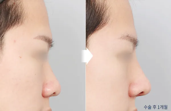 Before/After