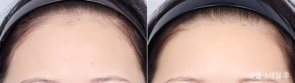 Before/After