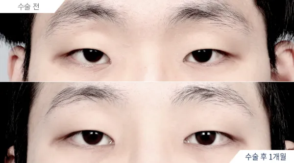 Before/After