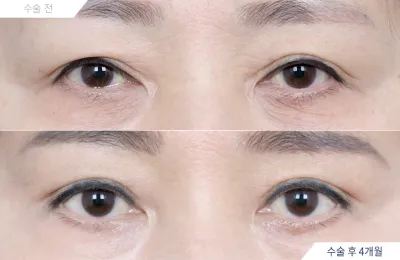 Before & After