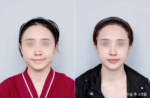 Before/After
