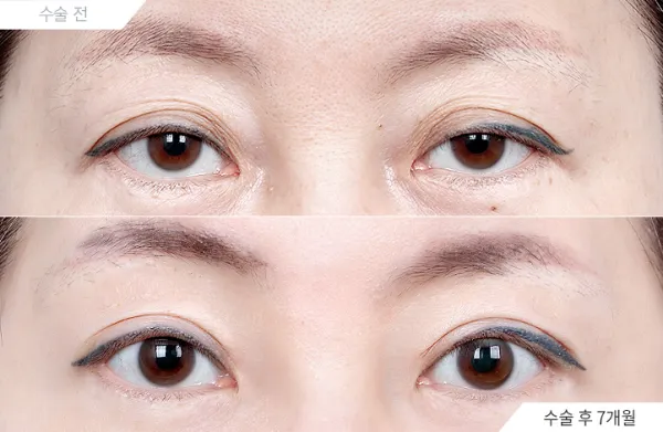 Before/After