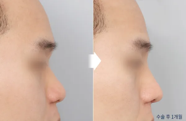Before/After
