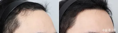 Before & After