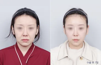 Before & After