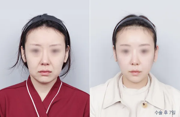 Before/After