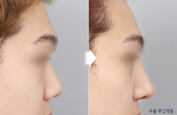 Before/After