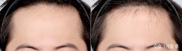 Before/After