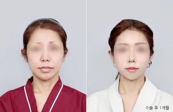 Before/After