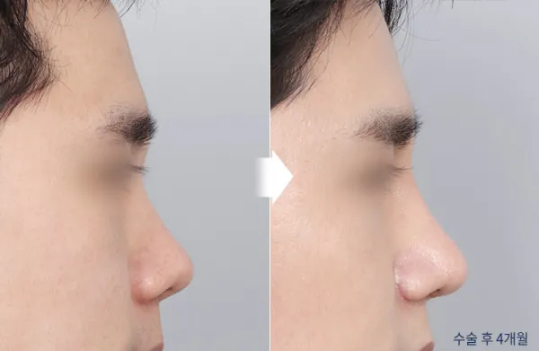 Before/After