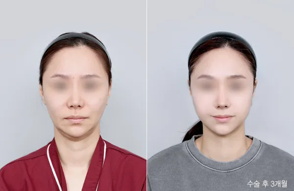 Before/After