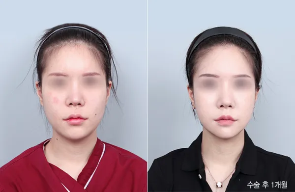 Before/After