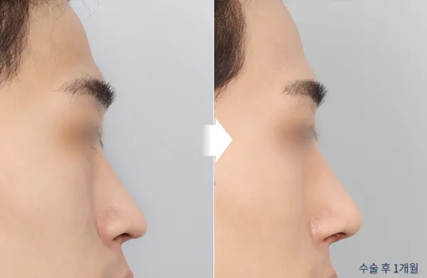 Before/After