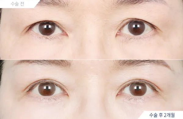 Before/After