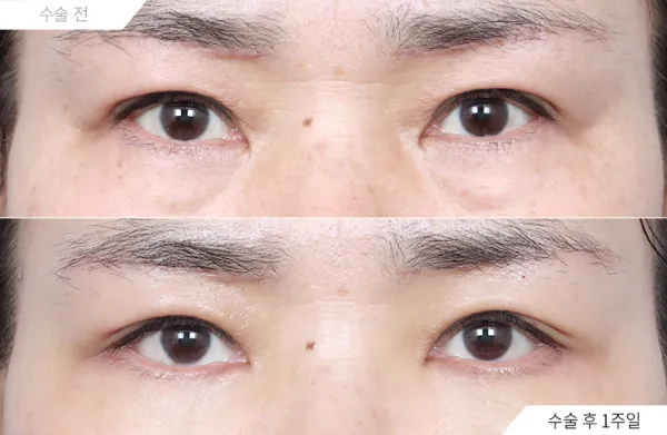 Before/After