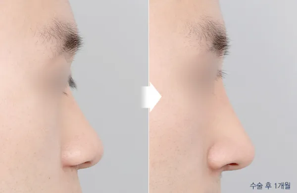 Before/After