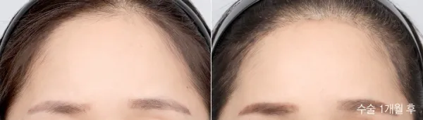 Before/After
