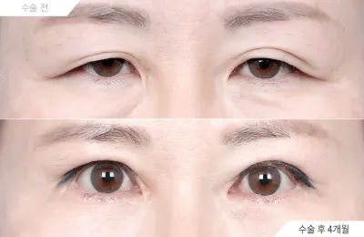 Before & After
