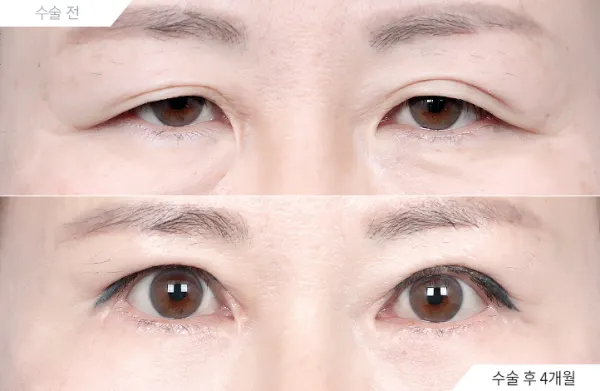 Before/After